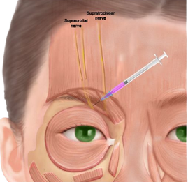 nerve supraorbital forehead eyebrow headache localized